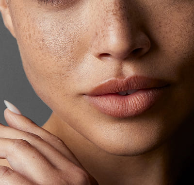 Smoothed scars and stretch marks