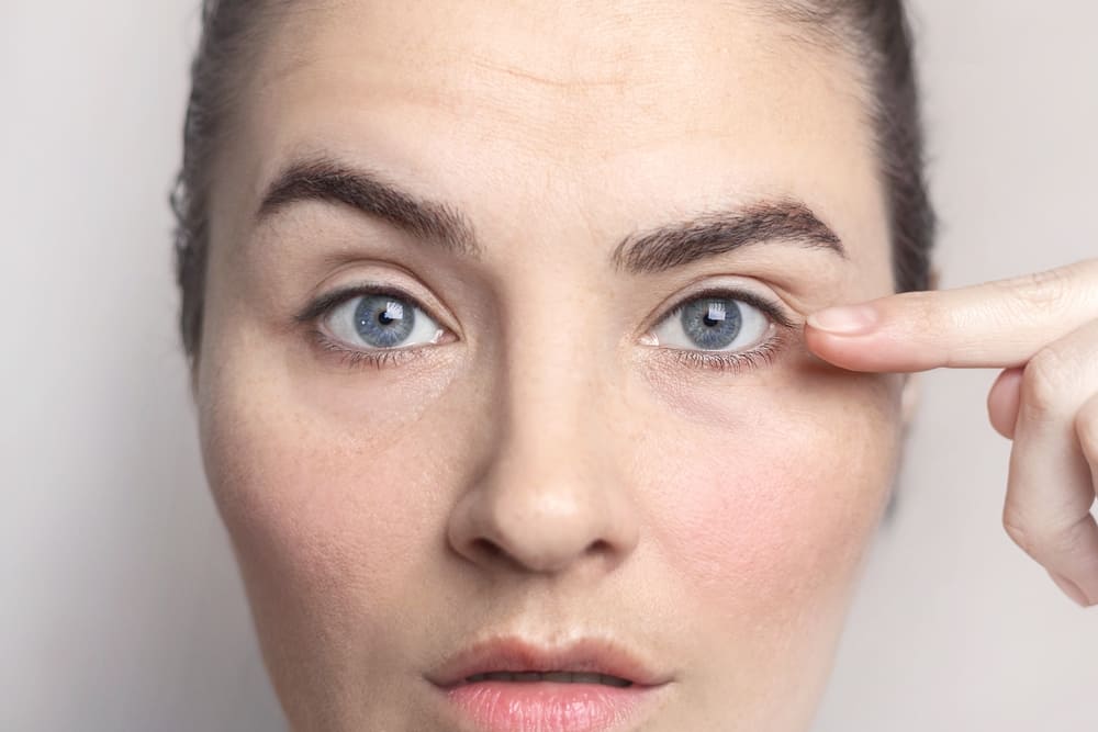 Woman pointing to under-eye area showing return of fine lines indicating timing for next Botox treatment