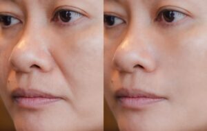 Side-by-side facial comparison showing Botox results duration across different areas of the face