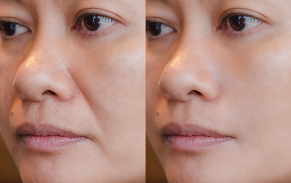 Side-by-side facial comparison showing Botox results duration across different areas of the face