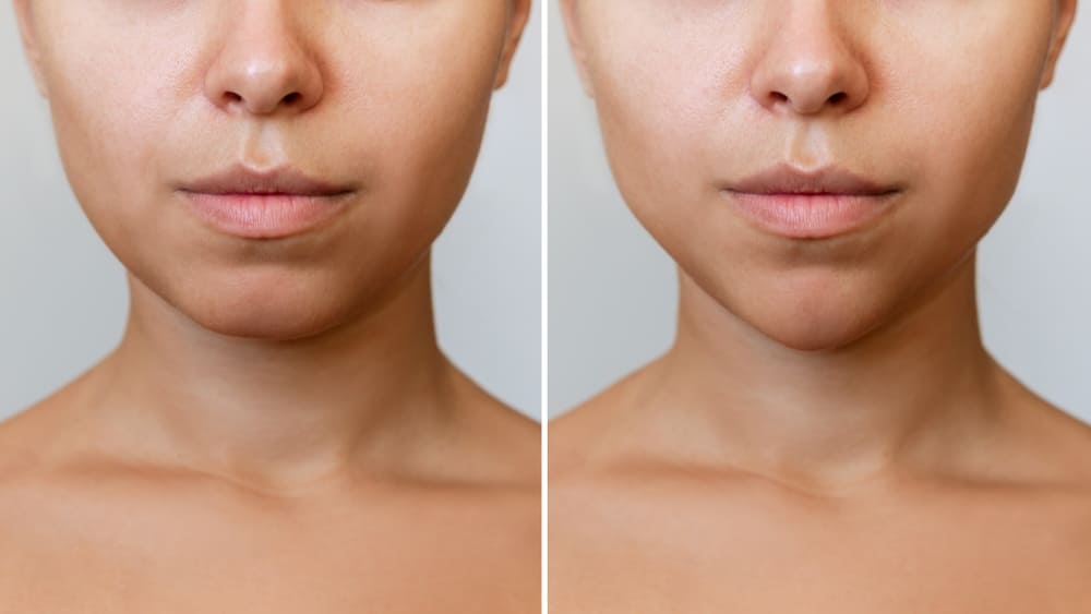 Before and after comparison showing slimmer jawline after Botox masseter reduction treatment
