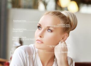 Woman with labeled facial lines showing crow’s feet, forehead, and smile lines targeted by Botox treatment