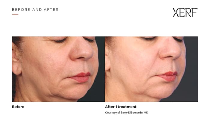Before-and-after XERF comparison showing firmer lower-face contours and reduced jowl prominence after one treatment.