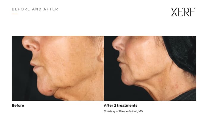 Side-profile before-and-after comparison showing a sharper jawline and firmer lower face after two XERF treatments.