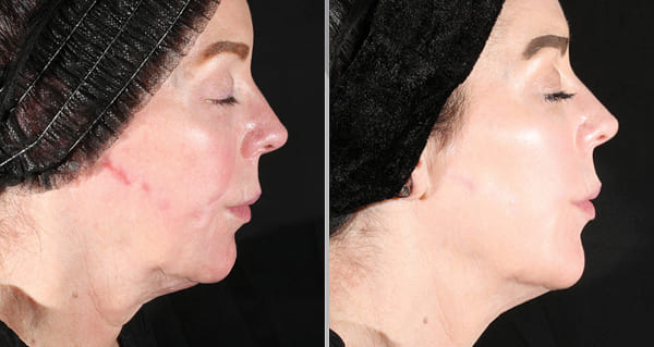 Side-profile before-and-after comparison showing firmer lower-face and neck contours after two XERF treatments.