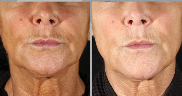 Front-view before-and-after comparison showing a more defined jawline and smoother neck following XERF treatment.