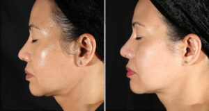 Side-profile before-and-after comparison showing smoother, firmer-looking skin following XERF treatment.