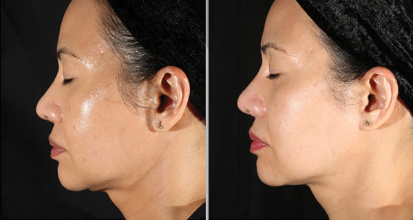 Side-profile before-and-after comparison showing smoother, firmer-looking skin following XERF treatment.